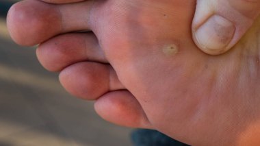 Siğilli beyaz bir adamın ayağını yakından çek. Elin parmakları iltihaplı bölgenin yakınındaki deriyi inceler..
