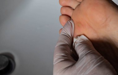 Siğilli beyaz bir adamın ayağını yakından çek. Elin parmakları iltihaplı bölgenin yakınındaki deriyi inceler..