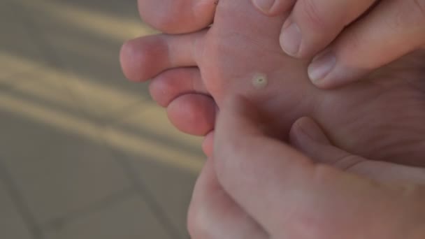 Zblízka Záběr Bradavičnaté Nohy Bělocha Prsty Ruky Zkontrolují Kůži Blízkosti — Stock video
