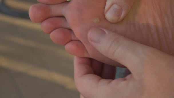 Close Shot Warty Caucasian Man Foot Fingers Hand Inspect Skin — Stock Video