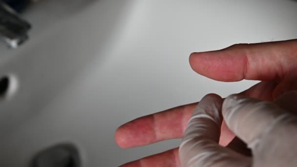 Zbliżenie Kciuka Prawej Ręki Białego Mężczyzny Cierpiącego Brodawki — Wideo stockowe
