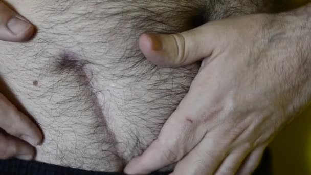 Homem Caucasiano Mostra Sua Cicatriz Devido Cirurgia Remoção Com Mãos — Vídeo de Stock