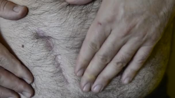 Кавказец Показывает Свой Шрам После Операции Удалению Руками Трогает Кожу — стоковое видео