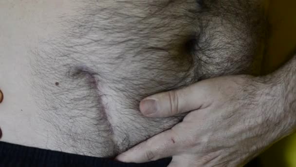 Hombre Caucásico Muestra Cicatriz Debido Cirugía Extracción Con Las Manos — Vídeos de Stock