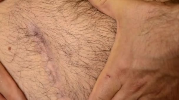 Caucasian Man Shows His Scar Due Removal Surgery His Hands — Stock Video