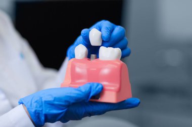 Doktor holding modeli diş diş implantı, closeup ile. Diş restorasyon. Dental implant montajı. Diş Protezleri. Yapay diş çelik iğne ile. Sözel kaygı ve diş hekimliği.