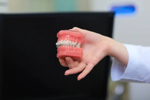 Dentiste tenant le modèle de dent avec des appareils dentaires métalliques câblés. Modèle dentaire orthodontique des dents avec implants dentaires ou mâchoire humaine. Image de magnifique prothèse dentaire. Focus sélectif sur les accolades . — Photo