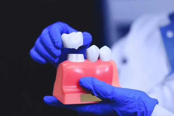 Ortodontik tedavi ile Diş implantları. Diş implantları ve diş gerçek doktor elinde. Diş crown, nakil ve modeli diş, diş hekimliği kavramsal projeler için iyi bir diş. Güzel sağlıklı dişler diş implantı konsepti için. 