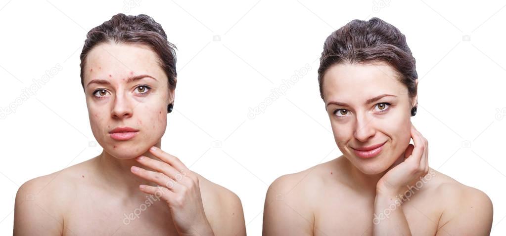 Young woman looking concerned about face skin problems and smiling after treatment. Before and after comparison. Isolated on white background.