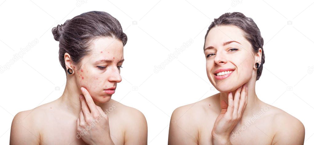 Young woman with cool  dark grey hair looking upset about face skin problems and joyful after treatment. Before and after comparison. Isolated on white background.