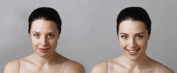 Comparison of woman with smiling face before and after treatment