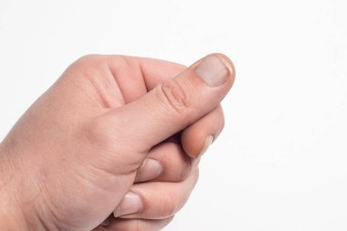 Kırılgan çivilerin yakın çekimi. Parmağında kırık bir tırnak. Tırnak bakımı ve sağlık kavramı.