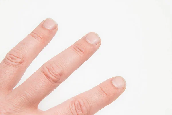 Feche Pregos Longos Unhas Quebradiças Dedo Conceito Cuidados Com Unhas — Fotografia de Stock