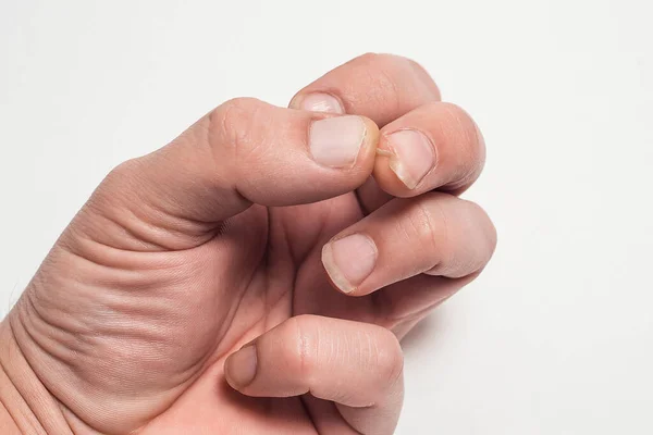 Close Van Broze Nagels Een Gebroken Spijker Aan Vinger Begrip — Stockfoto