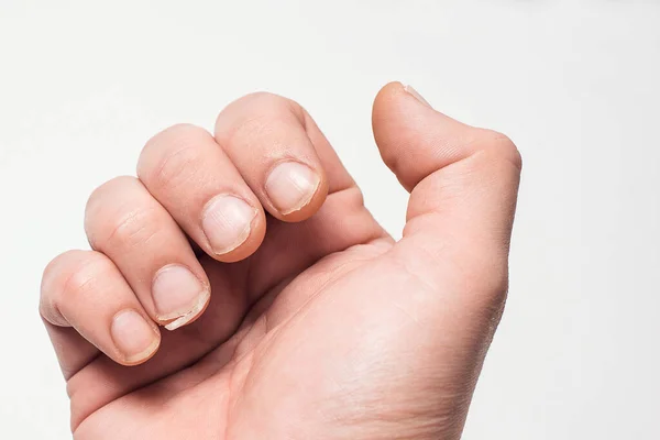 Fechar Unhas Mordidas Quebradiças Prego Partido Teu Dedo Conceito Cuidados — Fotografia de Stock