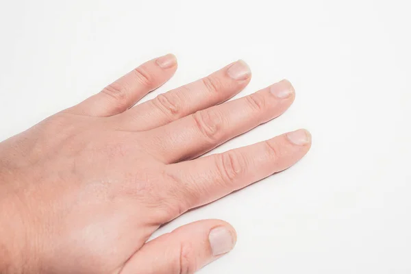Feche Pregos Longos Unhas Quebradiças Dedo Conceito Cuidados Com Unhas — Fotografia de Stock