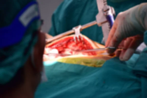Cirujano Realiza Injerto Bypass Arterial Para Cirugía Bypass Coronario Viwe —  Fotos de Stock