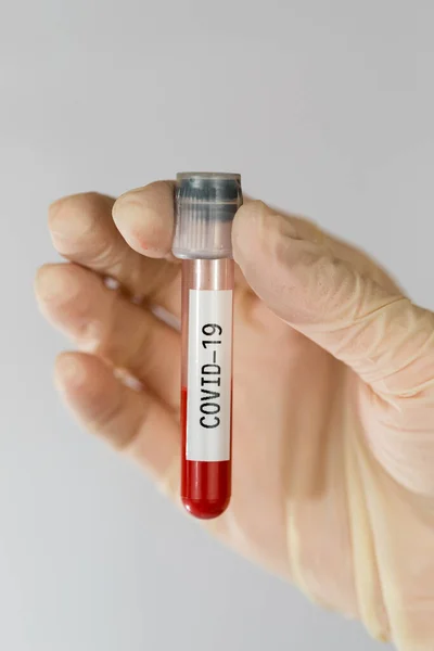 Laboratoryjna próbka krwi do diagnozy nowego zakażenia wirusem Corona Covid-19 z Wuhan w Chinach. Koncepcja zakażenia pandemią. — Zdjęcie stockowe