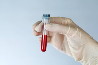 Hemşirenin elinde kan örneği olan test tüpü. Klinikteki virüsler için kan testi ve önlem alınması.