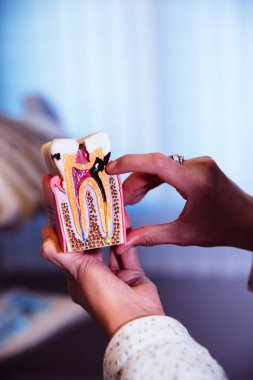 bir insan dişi modeli diş çürüğü ile holding eller