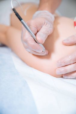 Electroacupunture kuru iğneleme yöntemlerinin etkinliğinin karşılaştırılması iğne makine gerekir bağlanma