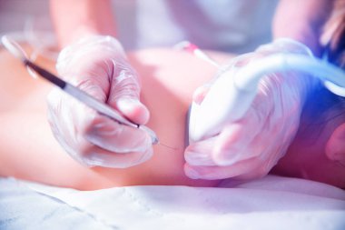 Ecography intratissue perkütan elektroliz fizik tedavi rehabilitasyon fizyoterapist tedavi makine Hastanesi Tıp Merkezi IPE fizik tedavi kliniği needling kuru ultrason destekli.