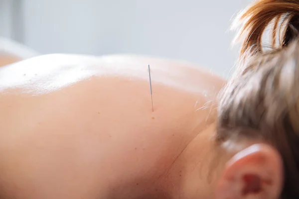 Fysiotherapeut doet acupunctuur om een jonge vrouw op haar rug — Stockfoto