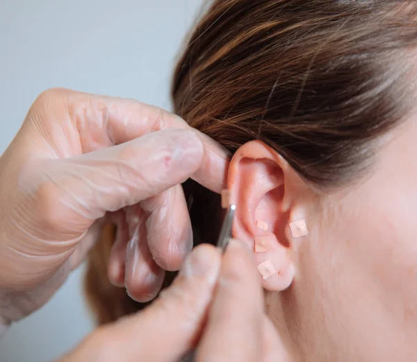 Dokter acupunctuurnaalden aanbrengend het oor — Stockfoto