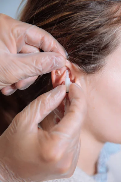 Orvos a fül akupunktúrás tűk elhelyezés — Stock Fotó