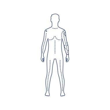 Yapay el siyah çizgi ikonu olan adam. Gerçek bir el yerine protezi olan biri. Web sayfası için piktogram, mobil uygulama, tanıtım. UI UX GUI tasarım elemanı. Düzenlenebilir vuruş.