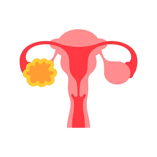 Polycystic Ovary Syndrome Flat Color Icon Female Reproductive System Disease — Stock Vector