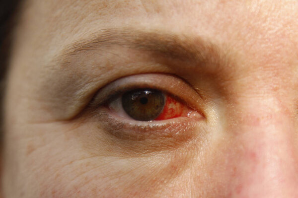 Close up of one annoyed red blood and health eye of female affected by conjunctivitis or after flu, cold or allergy. Concept of disease and treatment.