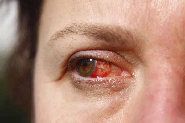 Κοντινό Πλάνο Ενός Ενοχλημένου Κόκκινου Αίματος Και Ματιών Υγείας Των — Φωτογραφία Αρχείου