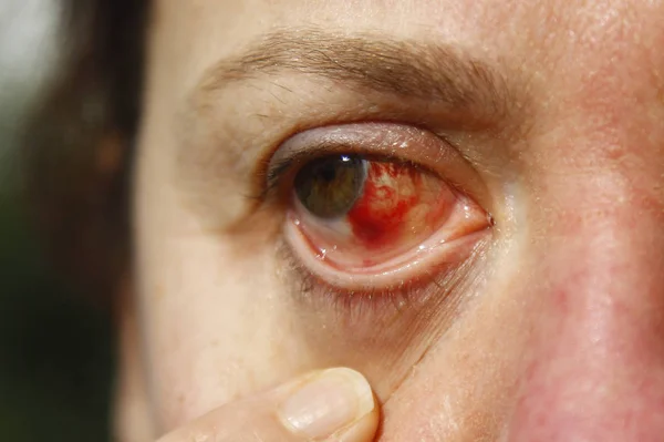 Κοντινό Πλάνο Ενός Ενοχλημένου Κόκκινου Αίματος Και Ματιών Υγείας Των — Φωτογραφία Αρχείου