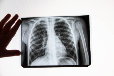 Hastalıklı bir insanın akciğerlerinin röntgeni. Coronavirus ya da kanser akciğerlere bulaştı. Virüs taraması