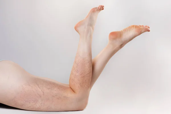 Понятие Варикозной Болезни Медицина Женщина Лежит Животе Тонкие Ноги Скрещены — стоковое фото