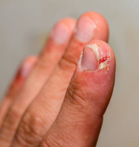 index finger dermatitis on male hand.