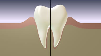 Periodontal hastalık. Diş eti iltihabı progresyon.