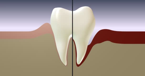 Periodontal Disease Treatment Gum Inflammation — Stock Video