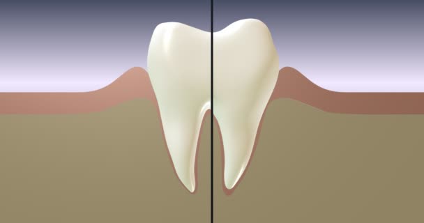 Periodontal Hastalık Diş Eti Iltihabı Progresyon — Stok video