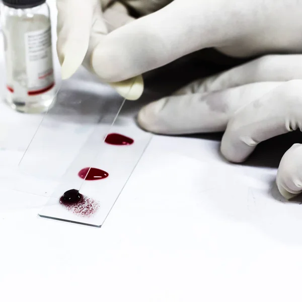 Agrupación de la sangre por aggutinación de diapositivas con un portaobjetos de vidrio — Foto de Stock