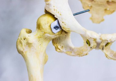 Kalça kemiği ve femur insan Kalça eklemi anatomisi beyaz arka planda gösterilen başkanı Belden kırma modeller