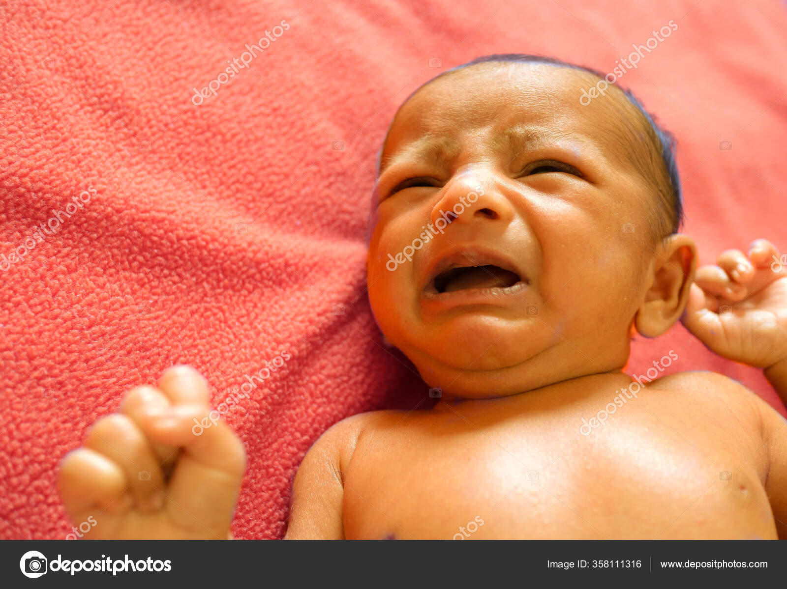 Kernicterus Bilirrubina Alta En Bebes Ictericia Neonatal