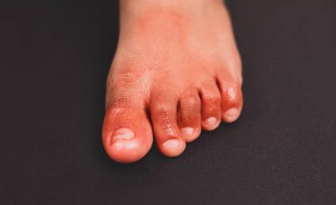 Painful red inflammation on toe called covid toe lesions strange sign of new coronavirus symptoms or infections clipart
