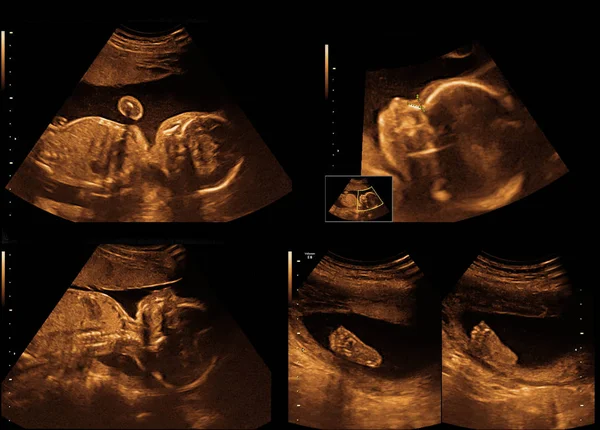 Baby on the ultrasound image — Stock Photo, Image