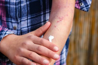 Bir çocuğun ellerinde atepik deri iltihabı.