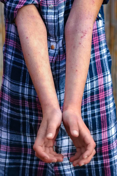 Wounds Atepic Dermatitis Hands Child — Stock Photo, Image