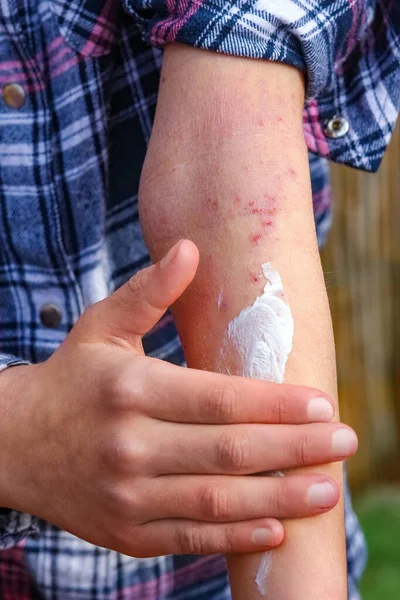 Wounds Atepic Dermatitis Hands Child — Stock Photo, Image