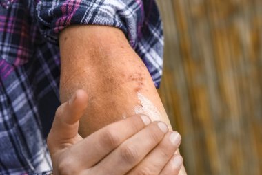 Bir çocuğun ellerinde atepik deri iltihabı.