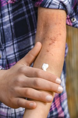 Bir çocuğun ellerinde atepik deri iltihabı.